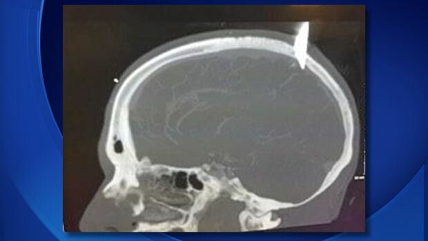 X-Ray of Man's Skull with a 12-Inch Kitchen Knife in it from Girlfriend. Man says it was "surreal."
